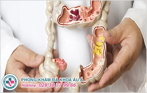 Khám hậu môn ở đâu Tp HCM – Phòng Khám Âu Á chuyên khoa hậu môn