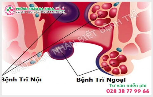 Phòng khám điều trị trĩ nội  tại TPHCM