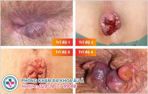 Ngứa hậu môn - nguyên nhân và cách điều trị hiệu quả