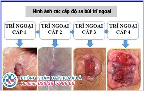 Bệnh trĩ ngoại và những điều cần biết