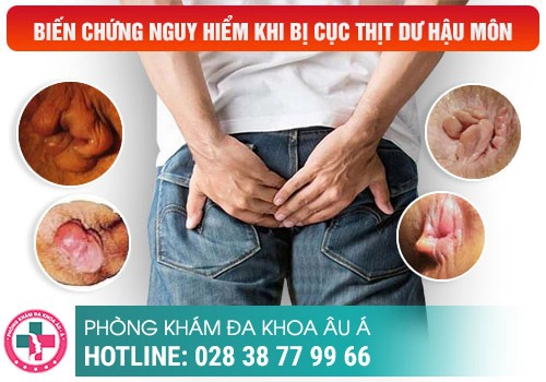 U nhú hậu môn và cách chữa trị hiệu quả