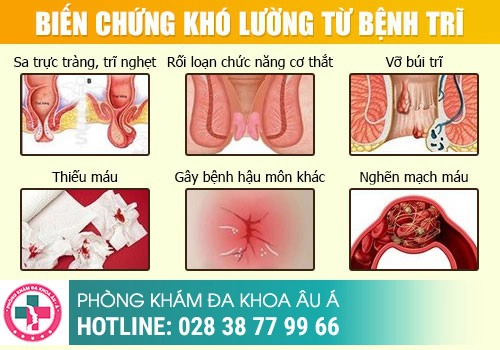 Bệnh trĩ bị viêm sưng to đau rát là bị gì?