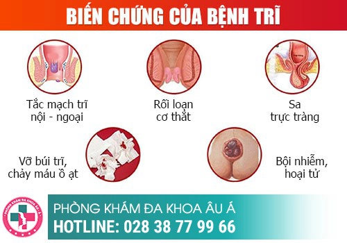 Mức độ nguy hiểm của bệnh trĩ 