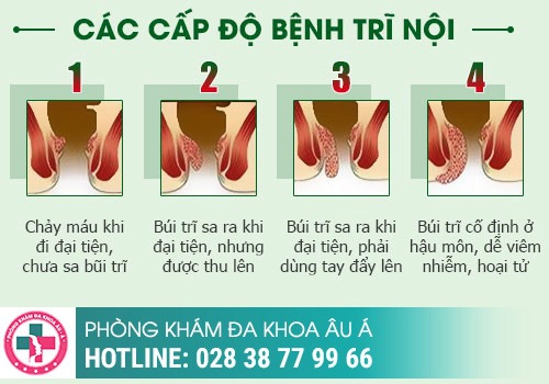 Vỡ Búi Trĩ Xung Huyết 