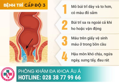 Mức độ nguy hiểm của trĩ nội độ 3 như thế nào?