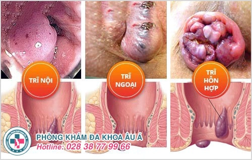 Các bệnh hậu môn trực tràng thường gặp và tác hại nguy hiểm