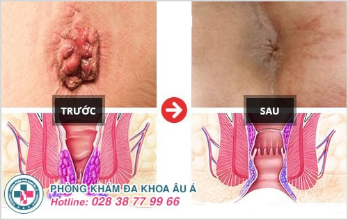 cách điều trị bệnh trĩ