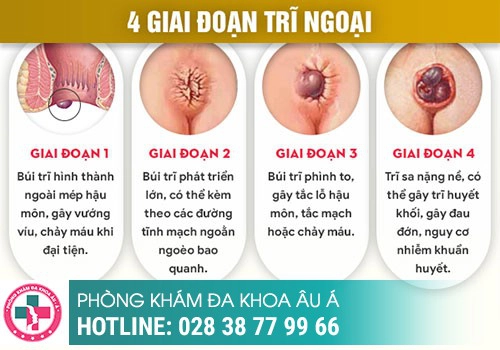 Vỡ Búi Trĩ Xung Huyết