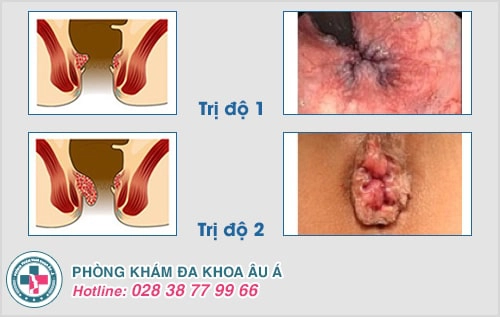 Cách điều trị bệnh trĩ không đau, chi phí rẻ năm 2021