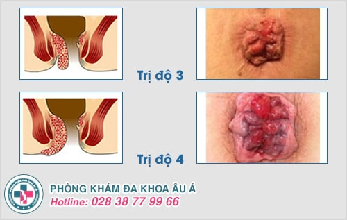 Cách điều trị bệnh trĩ không đau, chi phí rẻ năm 2021