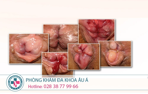 Cắt trĩ ở đâu tốt?