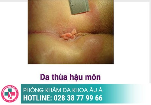 Da thừa ở hậu môn là dấu hiệu của bệnh gì?