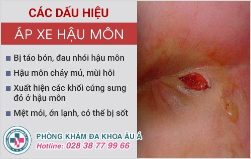 Dấu hiệu nhận biết và cách chữa áp xe hậu môn hiệu quả