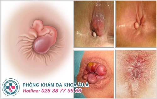 Bệnh trĩ là gì?