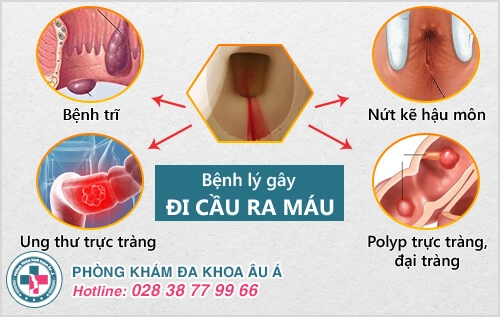 Đi vệ sinh ra máu là dấu hiệu của bệnh gì?