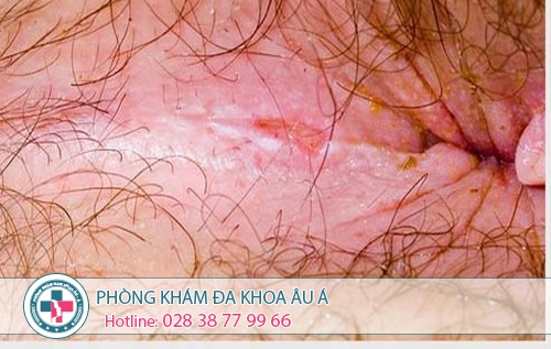 Đi ngoài đau rát hậu môn là bệnh gì?