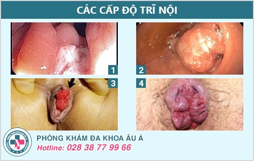 hình ảnh bệnh trĩ các cấp độ
