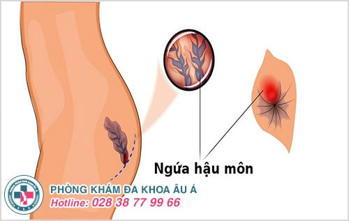 Ngứa hậu môn - nguyên nhân và cách điều trị hiệu quả