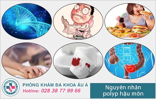 Polyp hậu môn và cách điều trị polyp hậu môn hiệu quả