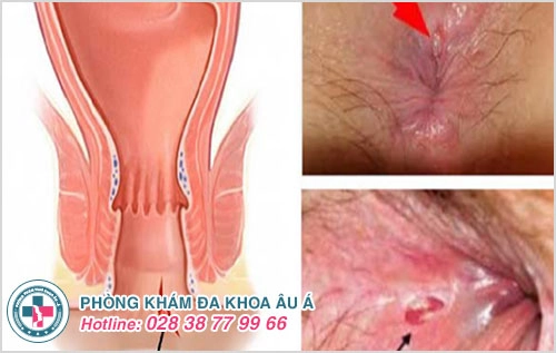 Các bệnh hậu môn trực tràng thường gặp và tác hại nguy hiểm
