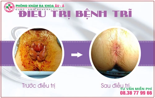 Phòng khám trĩ nào tốt  tại TPHCM? 