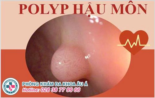 Polyp hậu môn và cách điều trị polyp hậu môn hiệu quả