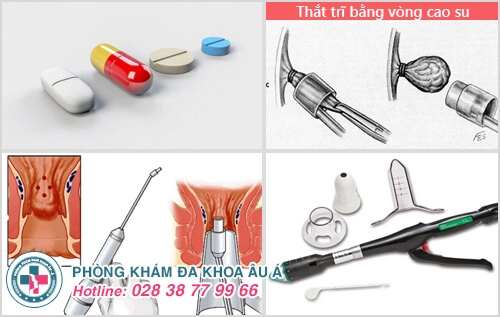 Những thông tin cần biết về bệnh trĩ nội độ 1, độ 2