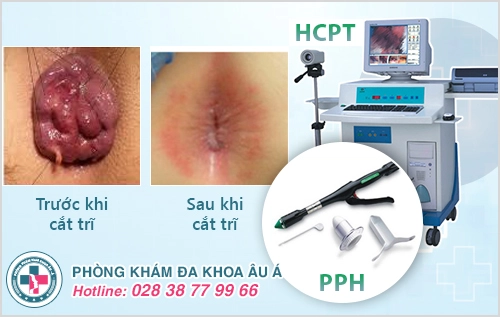 Chữa trĩ bằng công nghệ mới PPH và HCPT