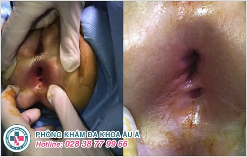 6 biểu hiện và dấu hiệu nhận biết bệnh rò hậu môn không nên bỏ qua