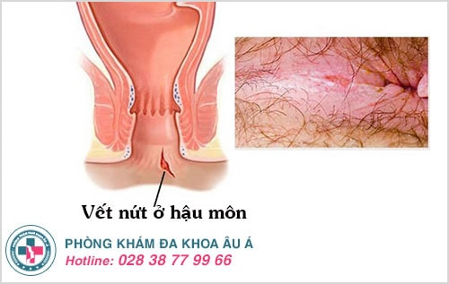 đau hậu môn, sưng hậu môn