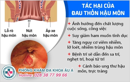 thốn hậu môn