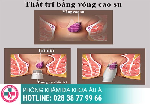 Phương pháp thắt búi trĩ có đau không?