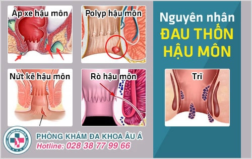 thốn hậu môn