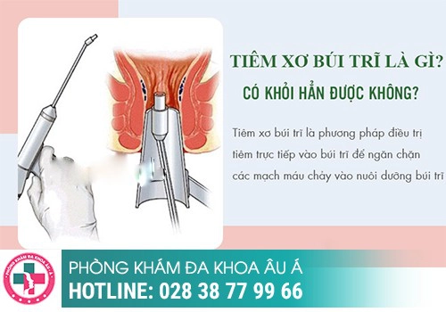 Điều trị trĩ ngoại tắt mạch bằng thuốc tiêm teo trĩ, tiêm xơ trĩ