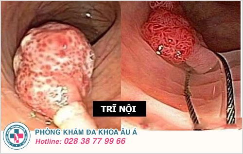trĩ nội trĩ ngoại
