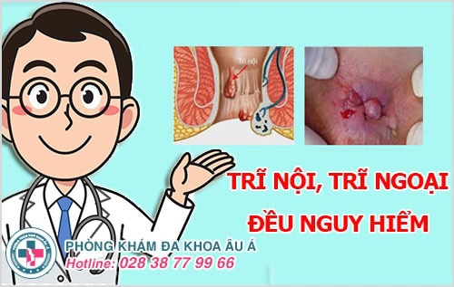 trĩ nội trĩ ngoại