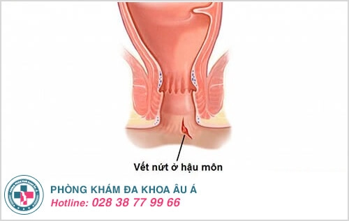 nứt hậu môn