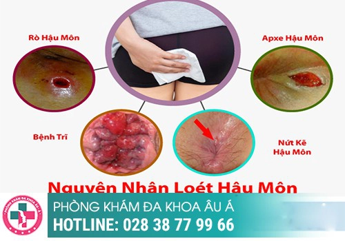 Nguyên nhân viêm hậu môn