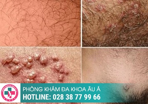 mụn rộp sinh dục