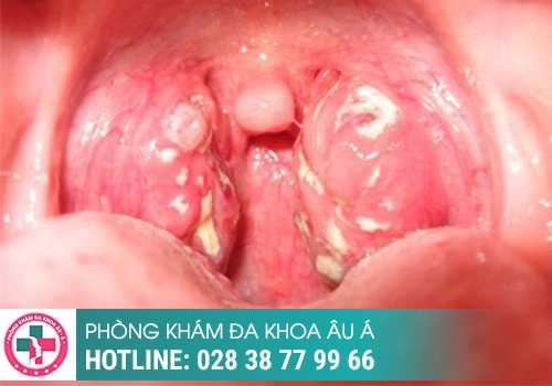 mụn rộp sinh dục