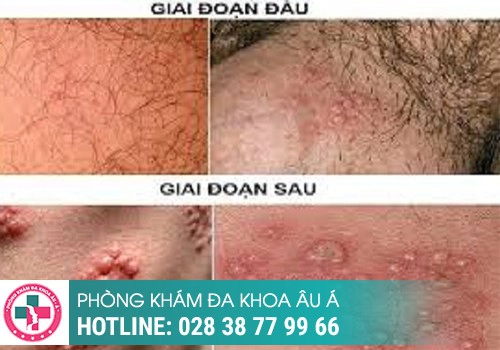 Mụn rộp sinh dục