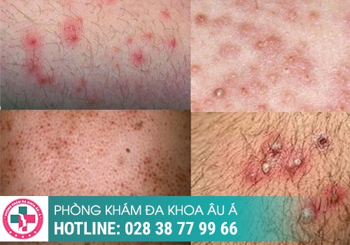 Hình ảnh nổi mụn trắng ở bìu tinh hoàn của nam giới
