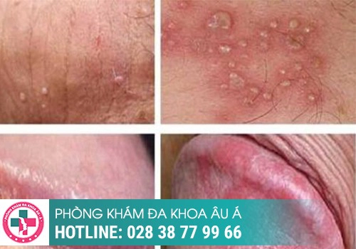 Tổng quan về mụn rộp sinh dục