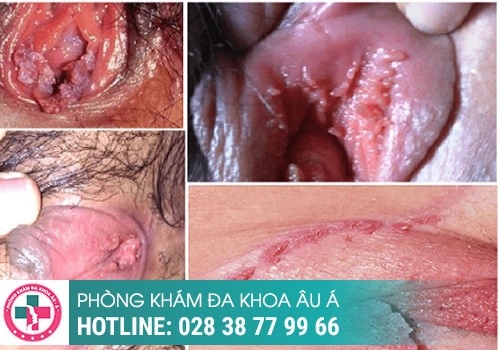 hình ảnh gai sinh dục