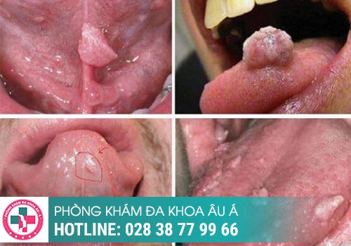 hình ảnh sùi mào gà