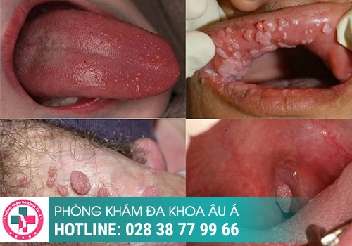 hình ảnh sùi mào gà