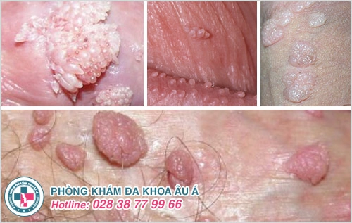 nổi mụn dương vật