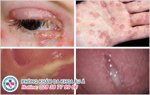 quan hệ tình dục không an toàn