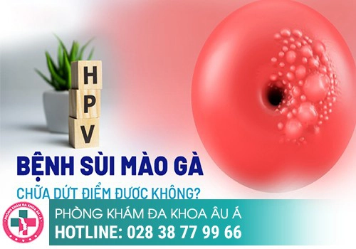 Bệnh sùi mào gà có chữa trị được không?