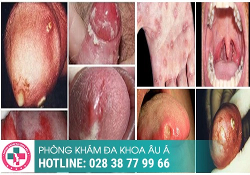 Hình ảnh về bệnh lậu ở nam giới 